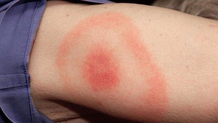 Lyme Disease in Humans