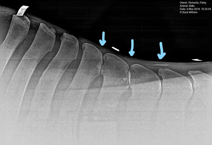 Diagnosis of Kissing Spines